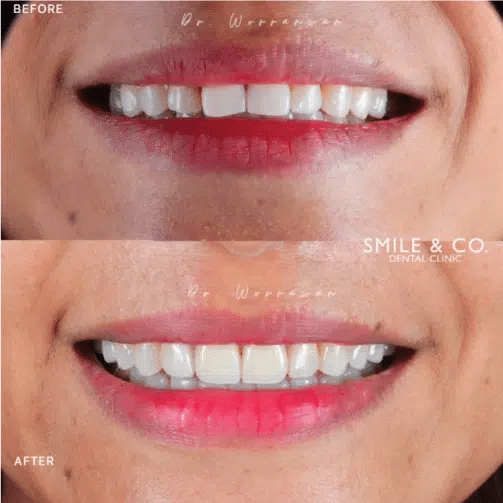 วิธีดูแลฟันหลังทำ Composite Veneer