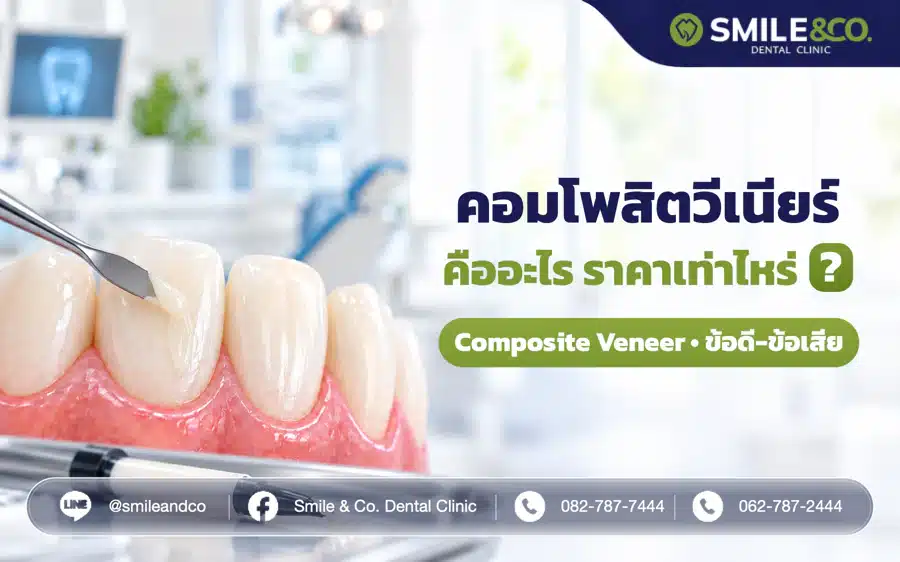คอมโพสิตวีเนียร์ (Composite Veneer) คืออะไร ข้อดี-ข้อเสีย ค่าใช้จ่ายที่ควรรู้!