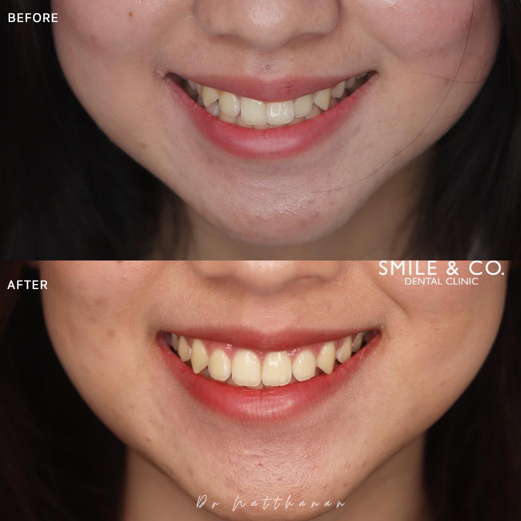 damon-braces-case-reviews-01