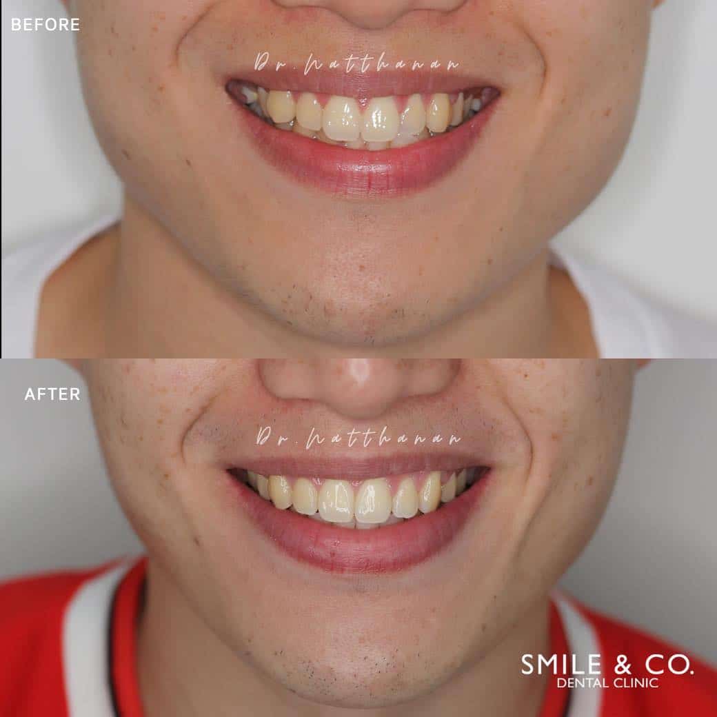 damon-braces-case-reviews-02