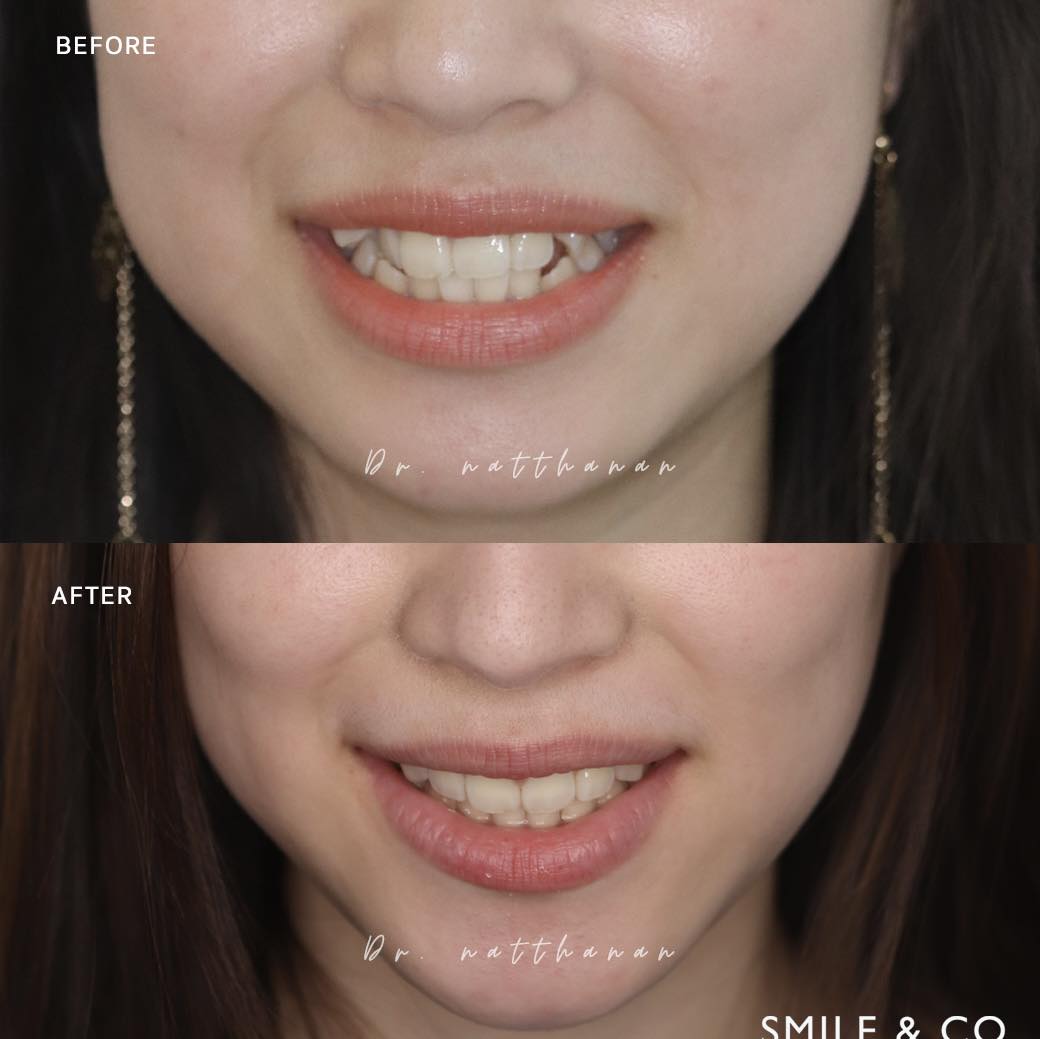 damon-braces-case-reviews-03