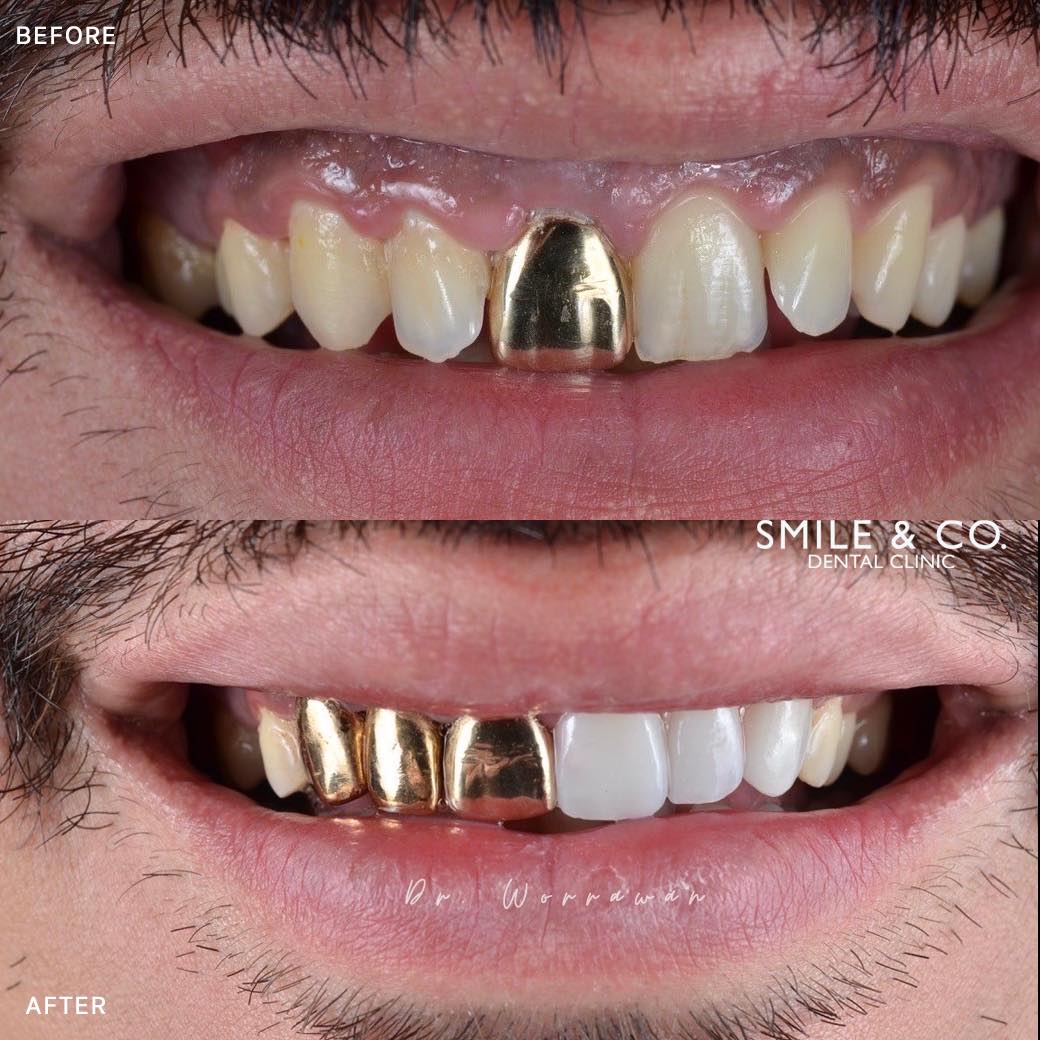dental-crowns-case-reviews-02