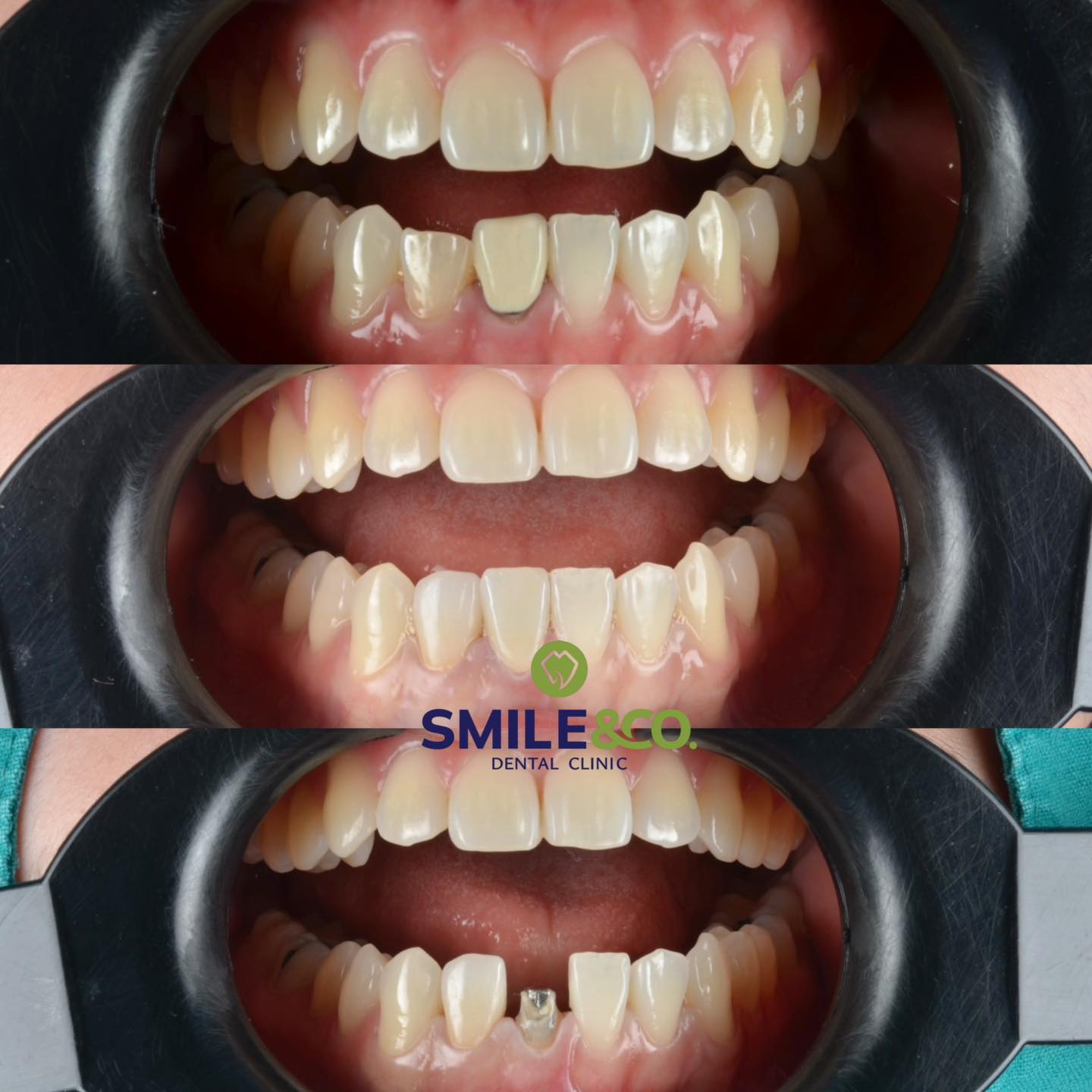 dental-crowns-case-reviews-04