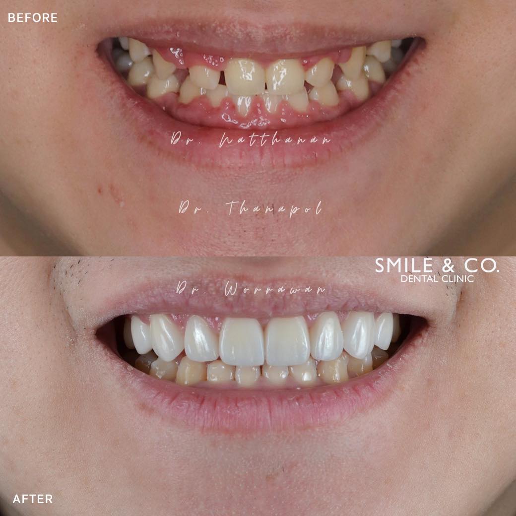gum-contouring-case-reviews-01