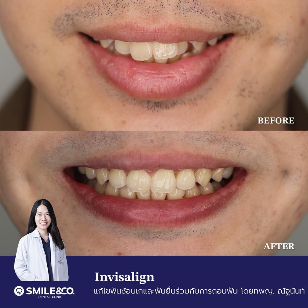 invisalign-case-reviews-03