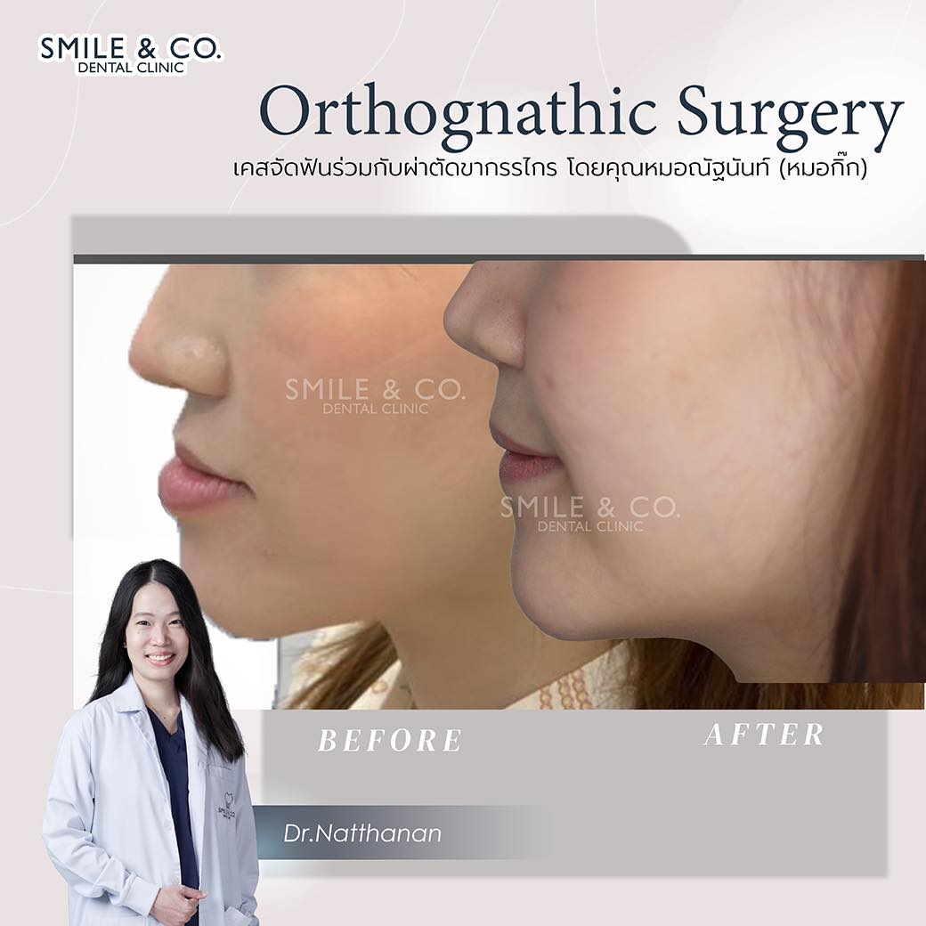 jaw-surgery-case-reviews-02
