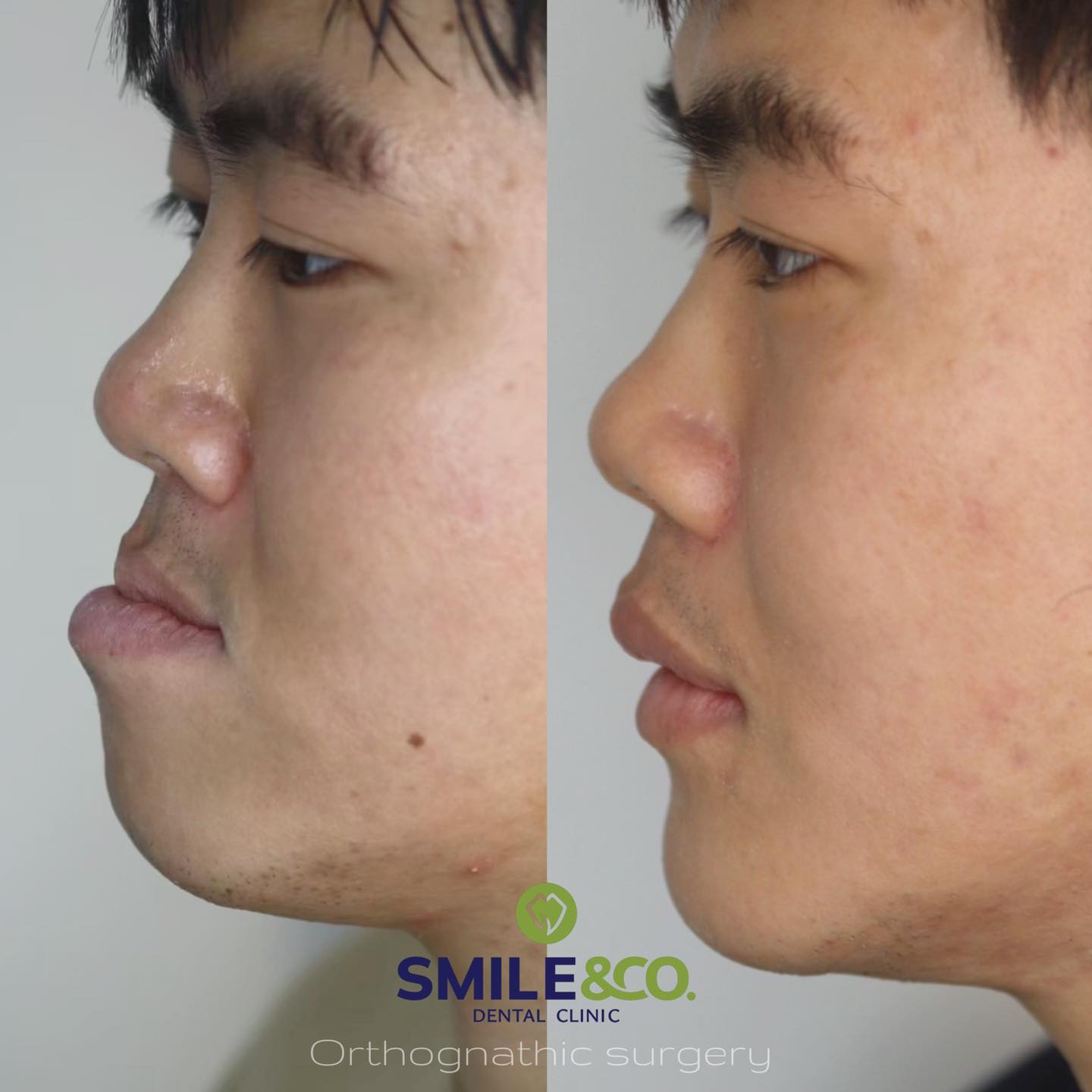jaw-surgery-case-reviews-04