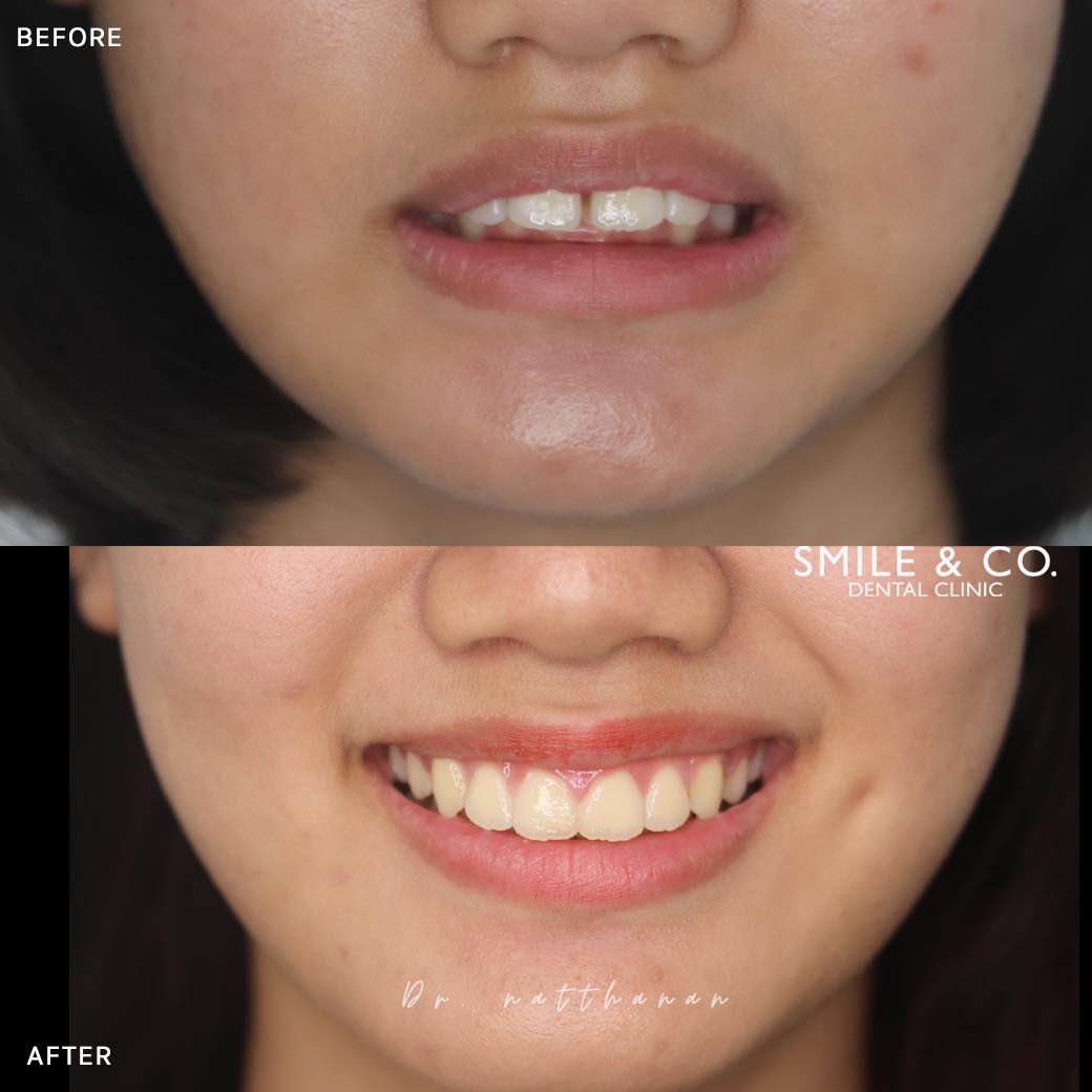 kids-braces-case-reviews-01