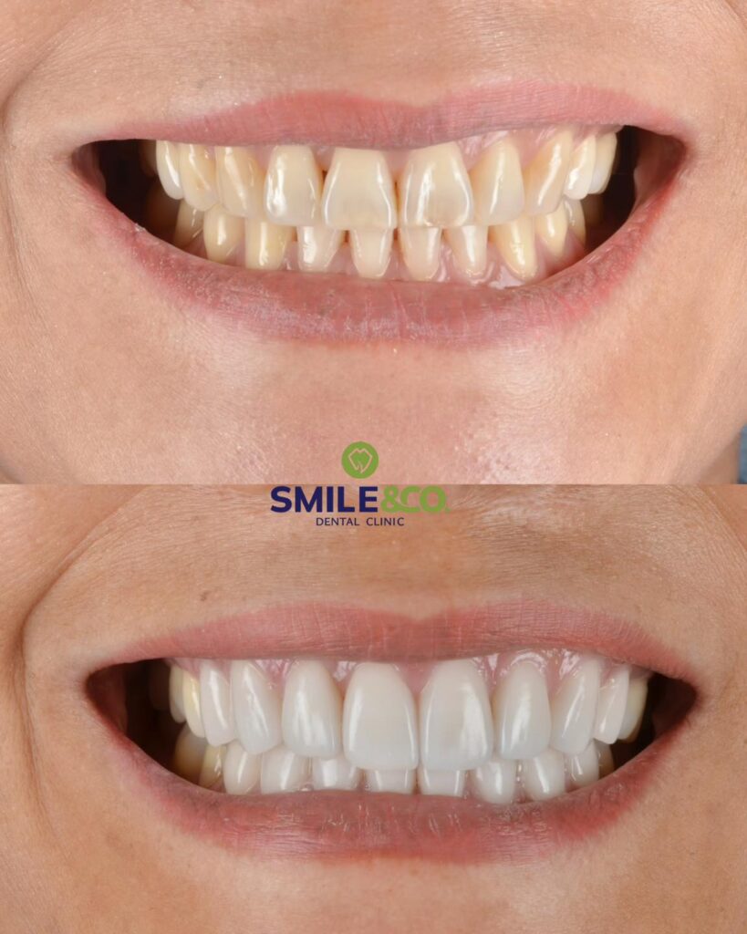 veneers-case-reviews-04