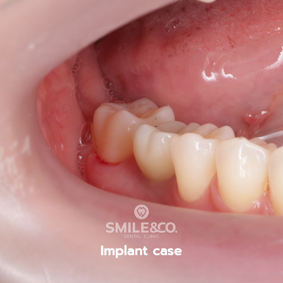 Implant case