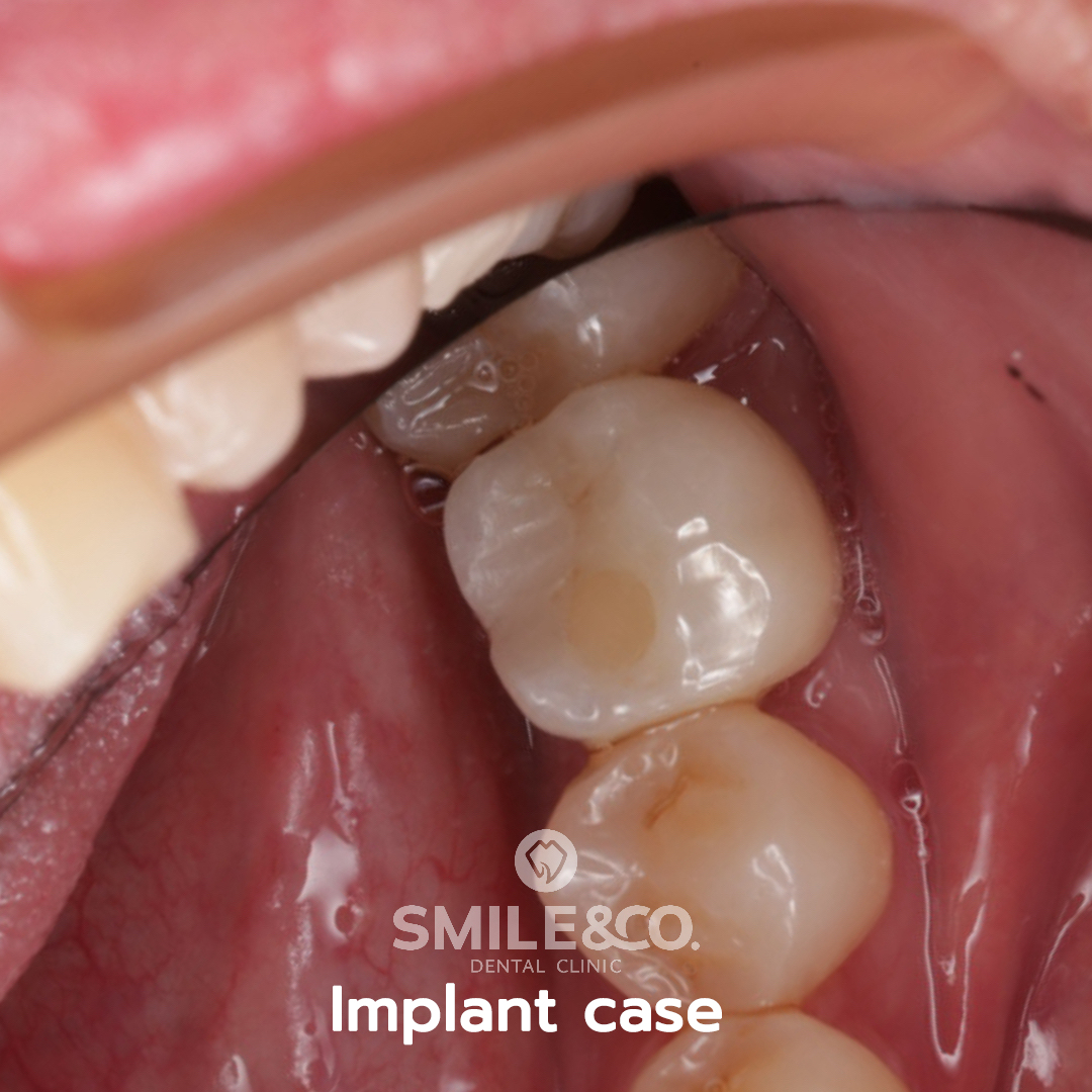 Implant case