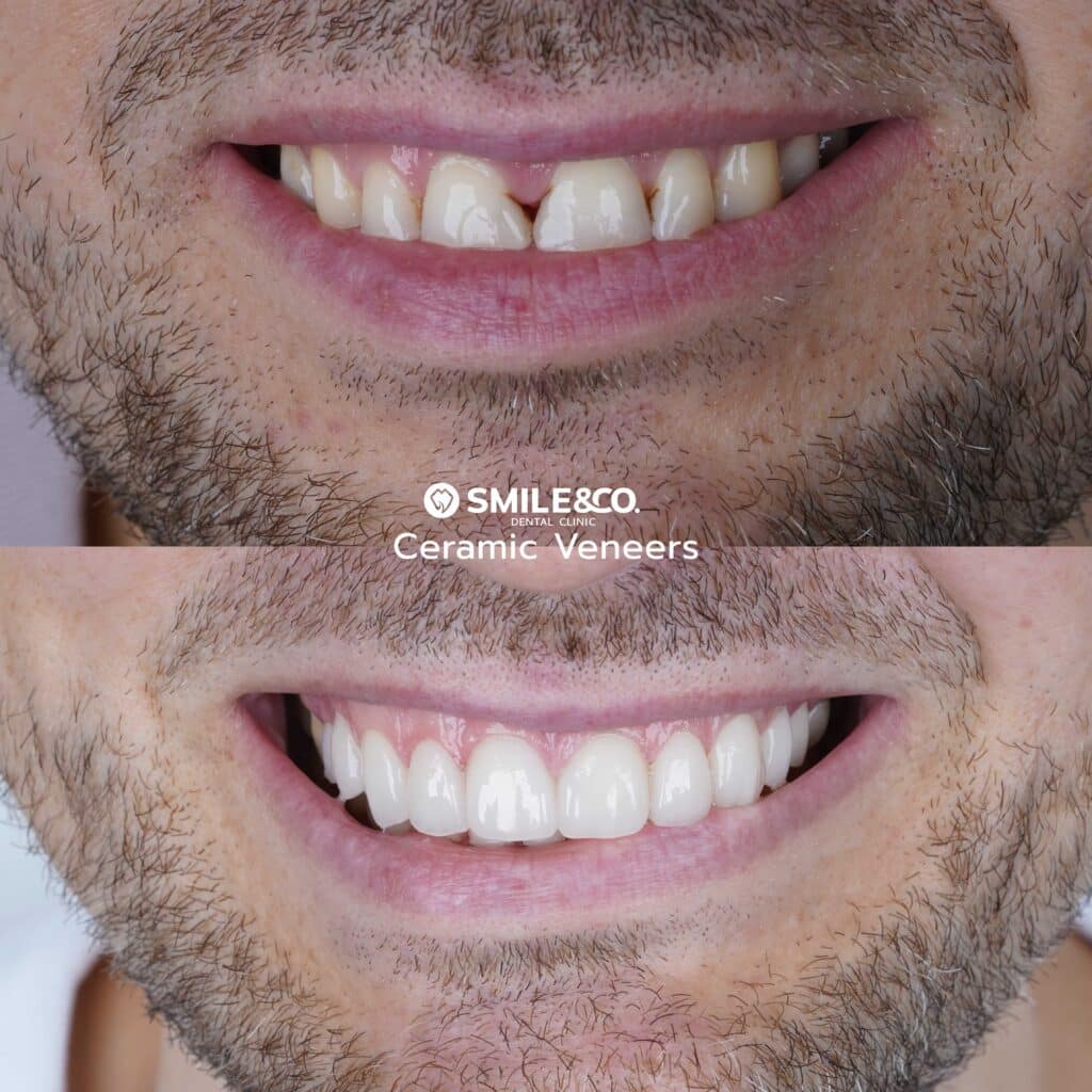 Ceramic veneers