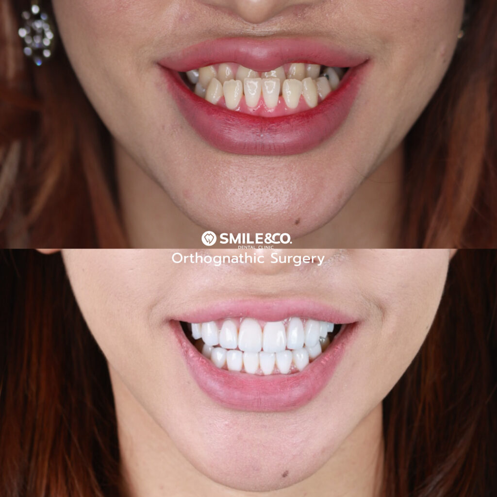 Orthognathic surgery