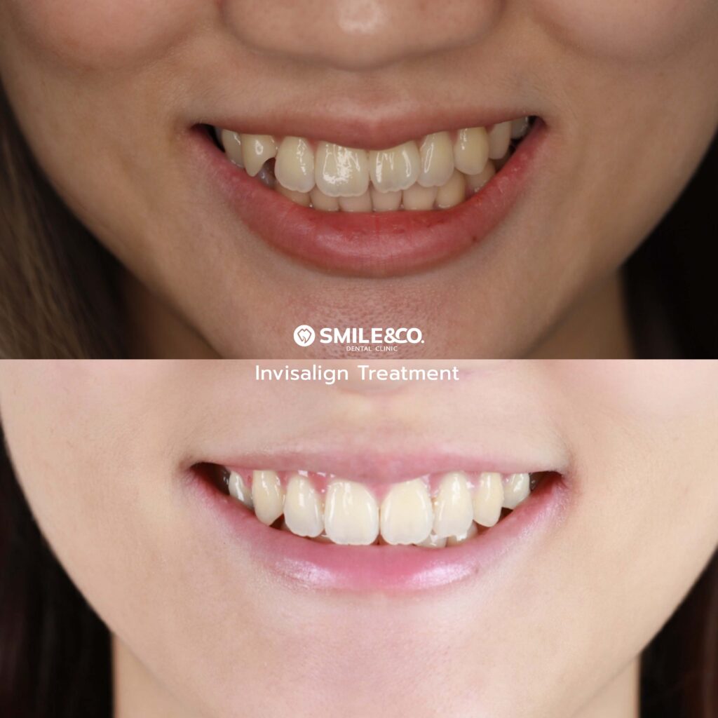 Invisalign case