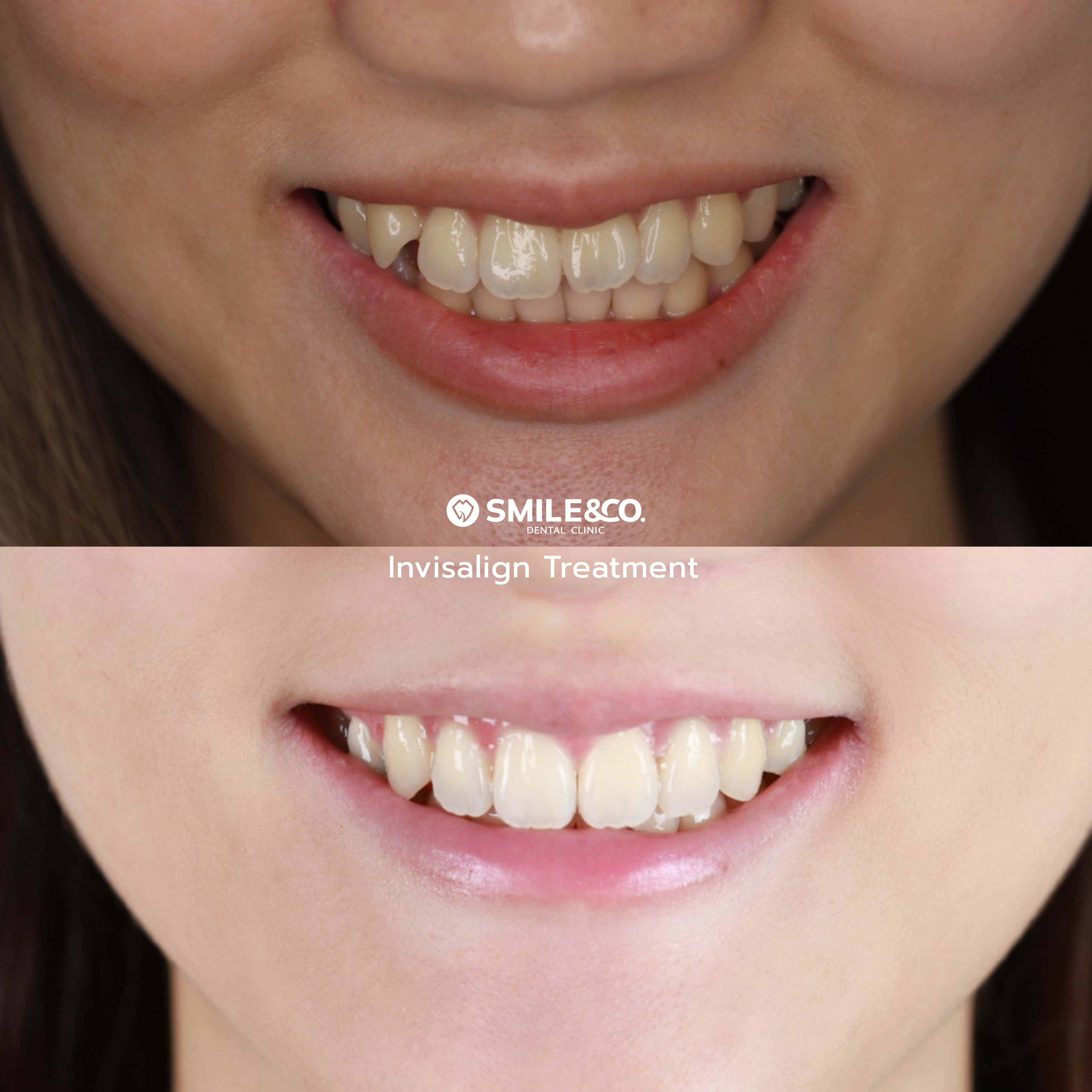 Invisalign case