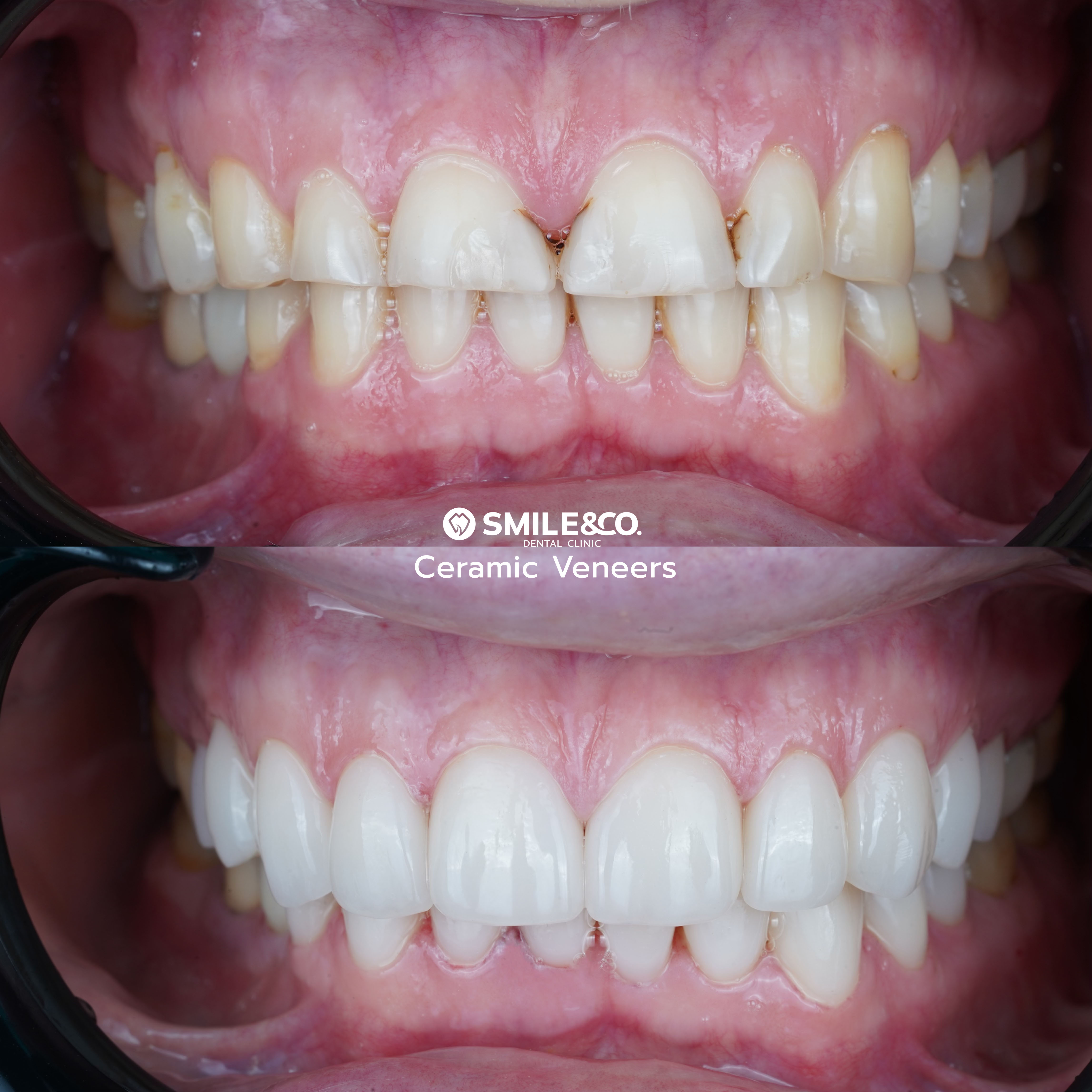 Veneer