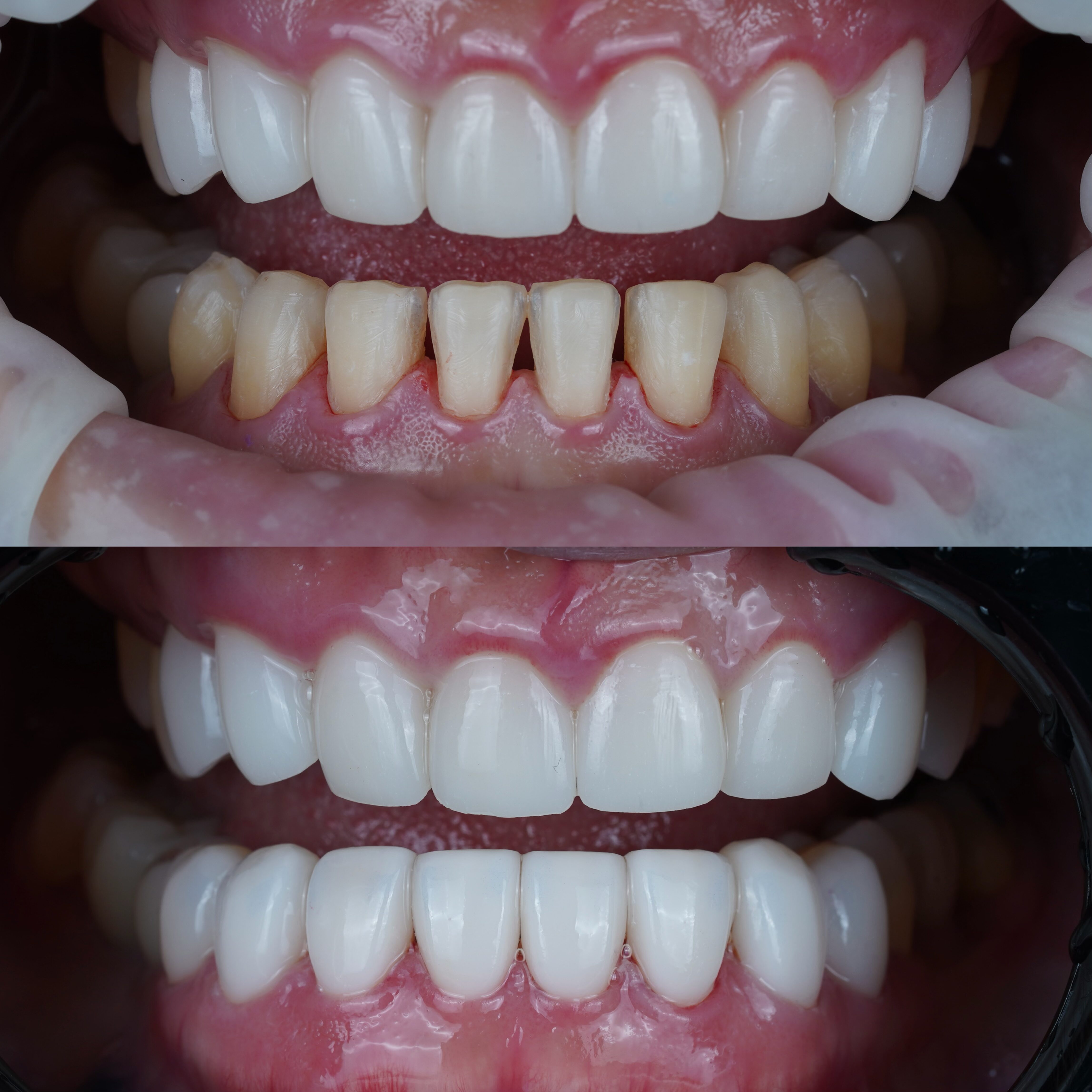 Ceramic Veneer