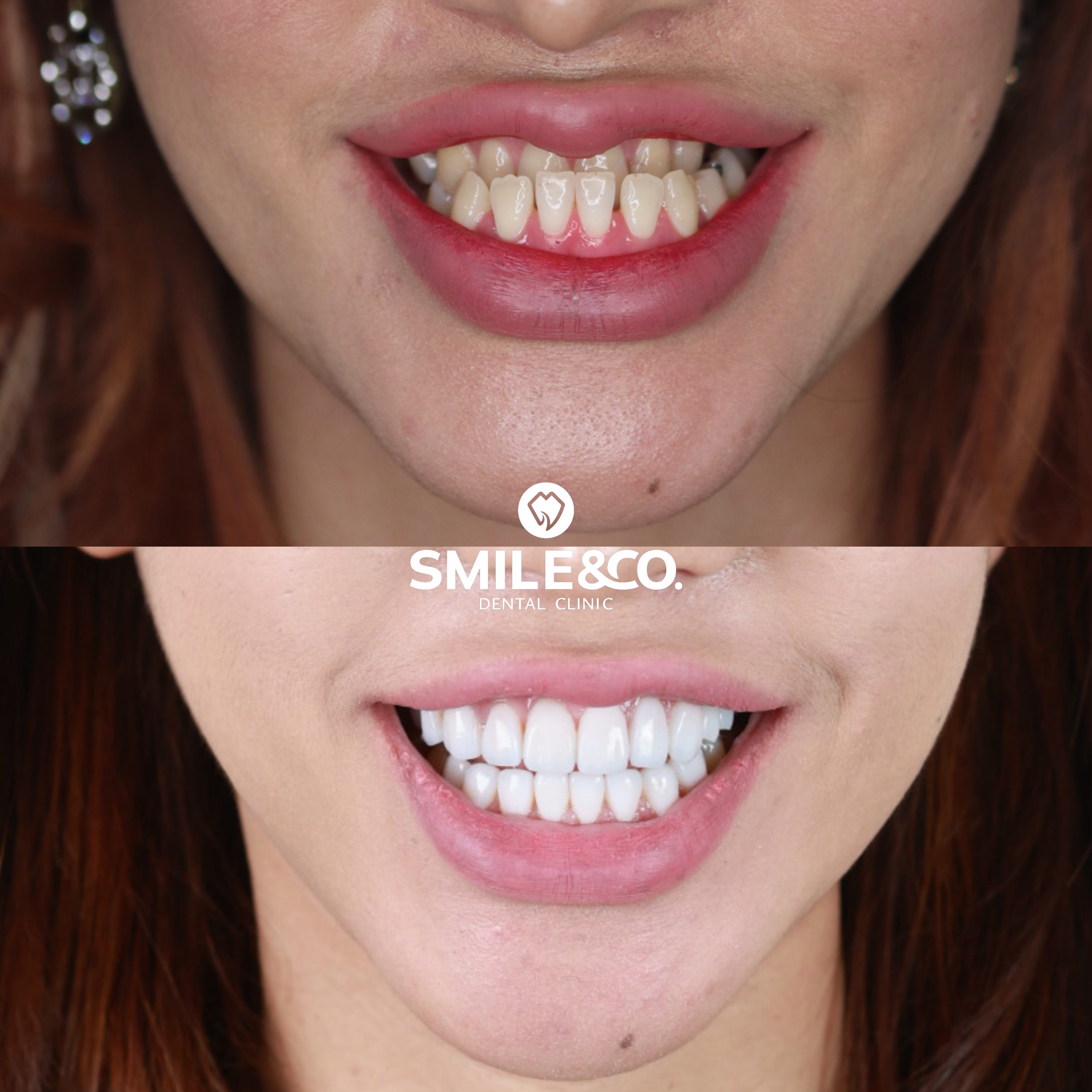 Ceramic Veneers