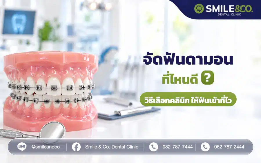 จัดฟันดามอน ที่ไหนดี เลือกคลินิกดัดฟันอย่างไร ให้ฟันเข้าที่ไว