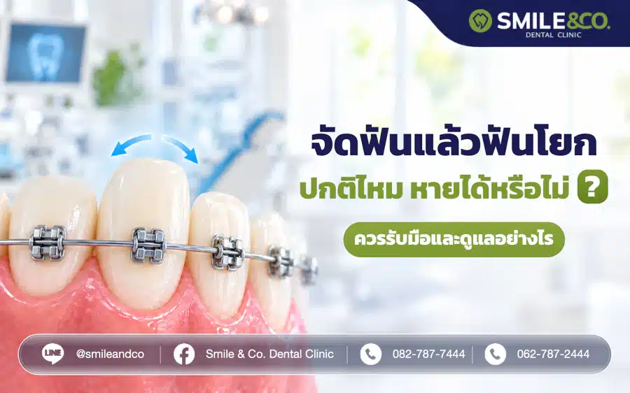 จัดฟันแล้วฟันโยก ปกติไหม มีโอกาสหายหรือไม่ ควรรับมืออย่างไร ?
