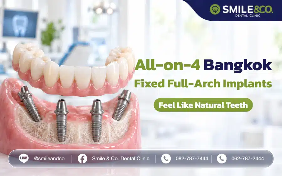 All-on-4 Bangkok: Fixed Full-Arch Dental Implants That Feel Like Natural Teeth