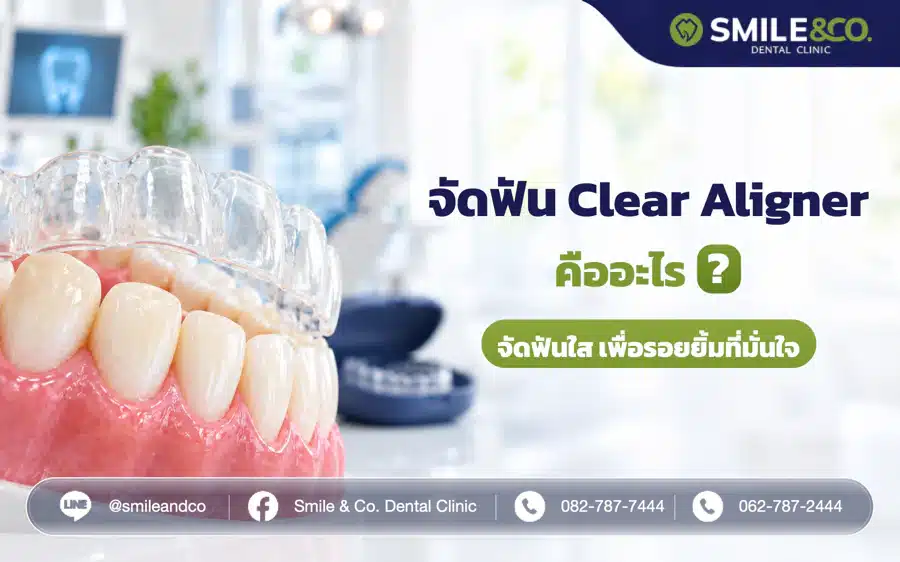 จัดฟัน Clear Aligner คืออะไร การจัดฟันใสคืนความมั่นใจให้กับทุกรอยยิ้ม