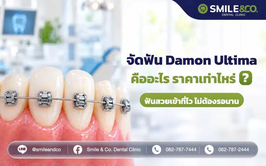 จัดฟัน Damon Ultima คืออะไร ราคาเท่าไหร่ ? ฟันสวยเข้าที่ไว ไม่ต้องรอนาน