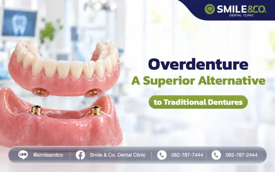 Overdenture: A Superior Alternative to Traditional Dentures