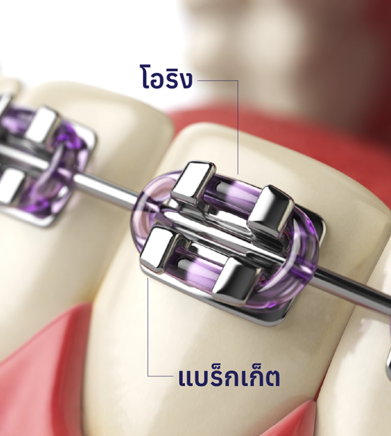 โอริงและแบร็กแก็ตจัดฟัน