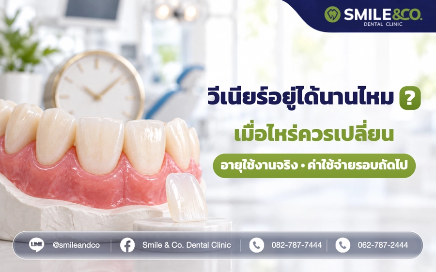 วีเนียร์ อยู่ได้นานไหม ? เมื่อไหร่ควรเปลี่ยน
