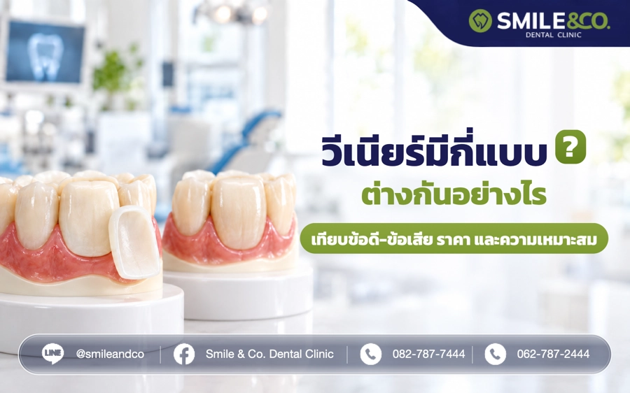 วีเนียร์ มีกี่แบบ ต่างกันอย่างไร ?